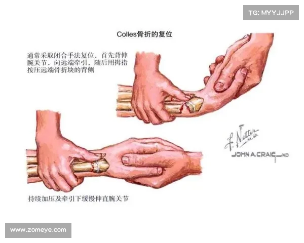 骨折治疗的新进展与康复方法探索:从早期干预到个性化恢复策略 骨折治疗的新进展与康复方法探索:从早期干预到个性化恢复策略
